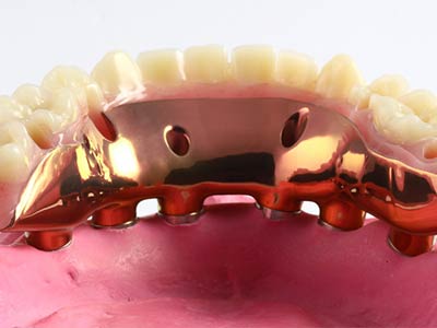 Clinique Cloutier denturologiste Montréal | Prostheses on implants
